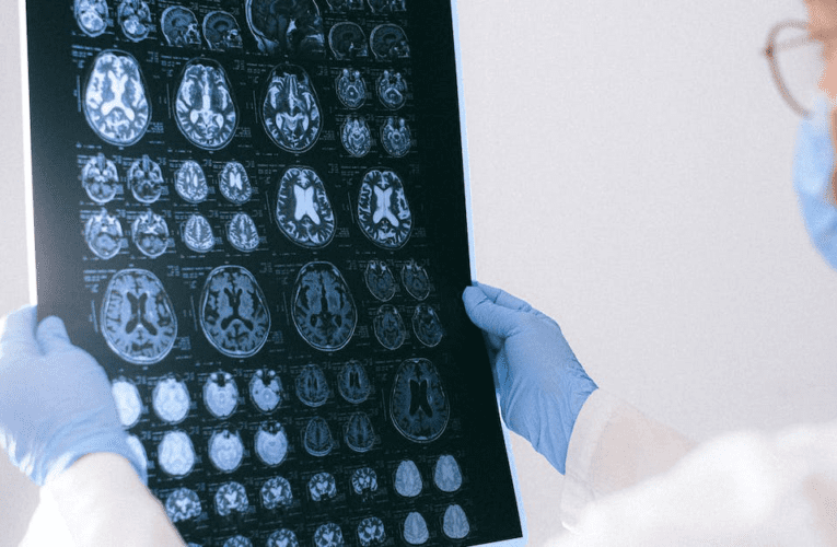 Jak uzyskać odszkodowanie z ZUS po udarze mózgu?